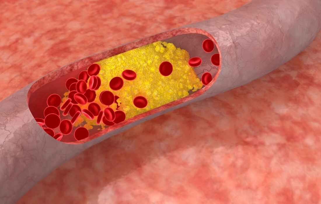 Colesterol alto pode contribuir para o surgimento de doenças cardiovasculares