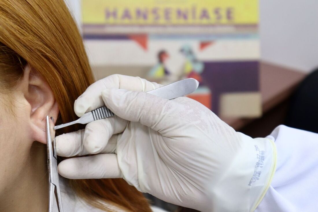 Carreta disponibiliza exame gratuito de hanseníase