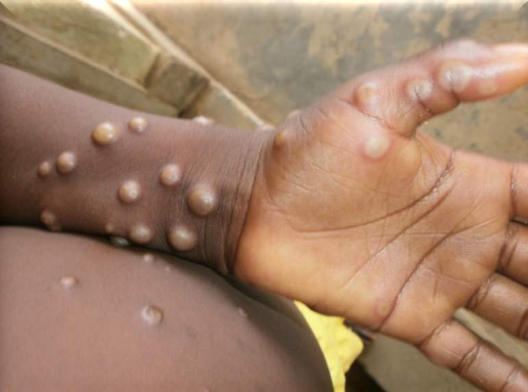 Surto de mpox se disseminou pelo mundo