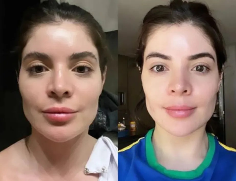 Gkay: Existe forma segura de retirar o preenchimento facial como fez a  influenciadora? Entenda - Folha PE