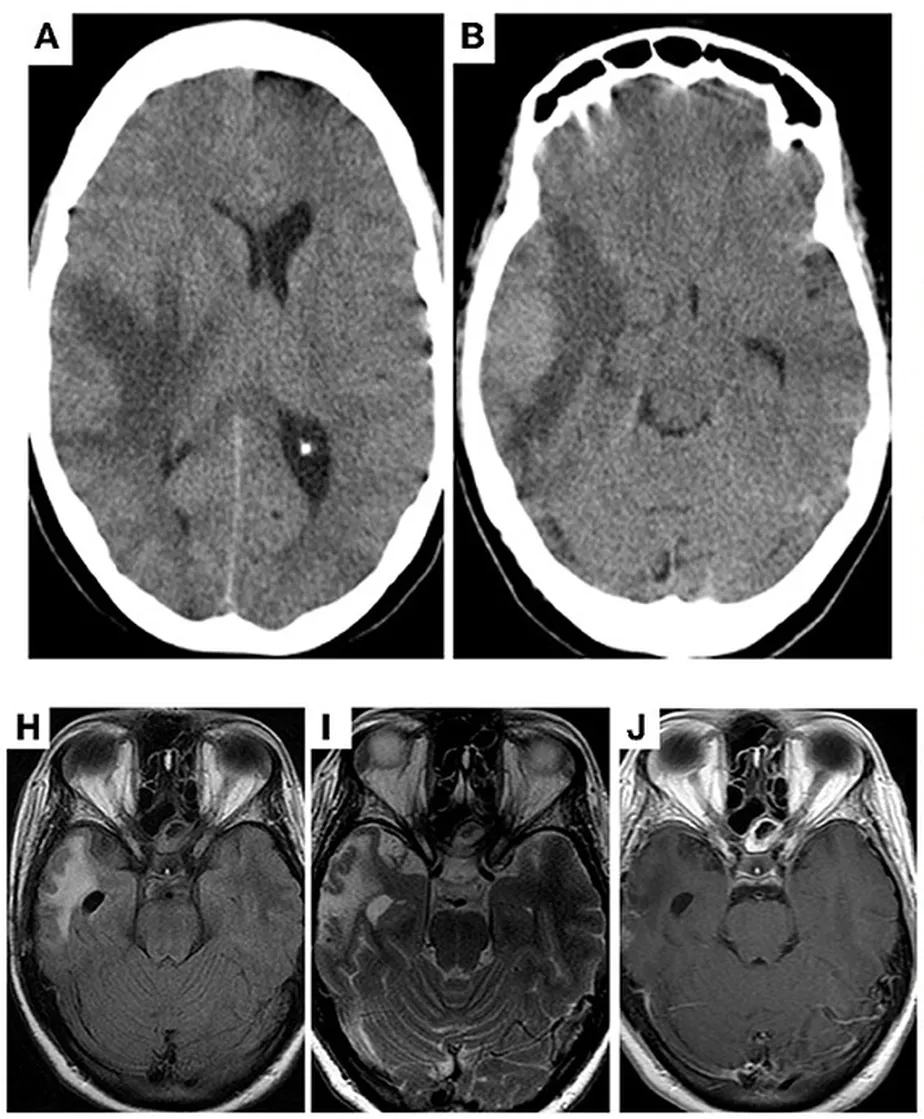 Imagens cerebrais de paciente que teve câncer cerebral revertido após ser infectada por arbovírus