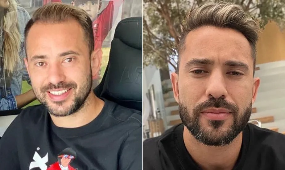 Não foi só Everton Ribeiro: veja antes e depois de jogadores que fizeram transplante  capilar - Folha PE