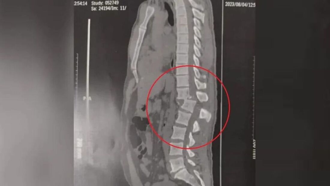 Uma imagem de tomografia realizada na coluna de Regilâneo da Silva Inácio, de 42 anos, mostra a gravidade da lesão sofrida por um aparelho em uma academia 