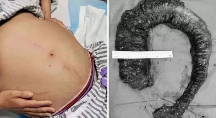 Na China, uma mulher de 53 anos passou por uma cirurgia de emergência para retirada de um cocô gigante