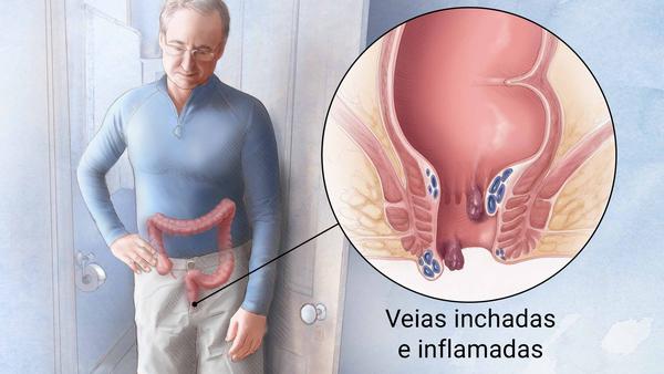 As hemorroidas podem ser classificadas de duas formas, a depender do local onde o problema aparece