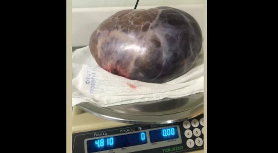 Tumor com cerca de 5 kg é retirado de mulher em cirurgia de emergência em Juiz de Fora