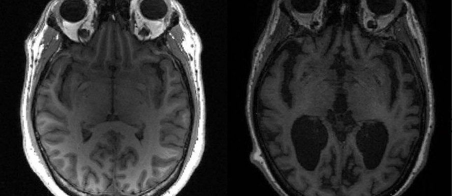 Imagem mostra cérebro saudável à esquerda e cérebro com Alzheimer à direita