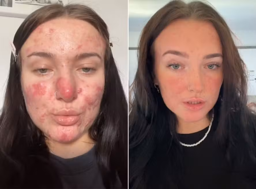 Courtney Jones tinha acne cística, com manchas vermelhas e inflamadas no rosto e pescoço
