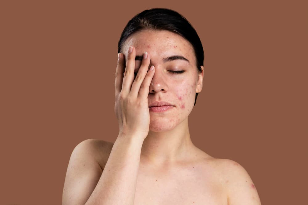 Acne hormonal é comum entre as mulheres ao longo da vida