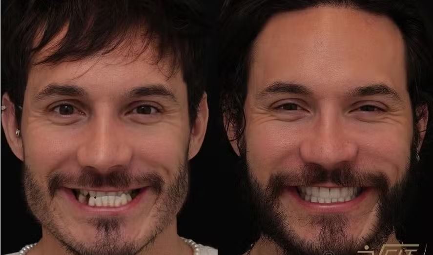 Antes e depois da camuflagem ortodôntica de Eliezer 