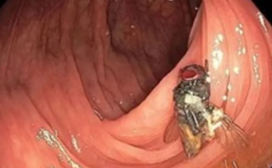 Mosca intacta estava no cólon do paciente