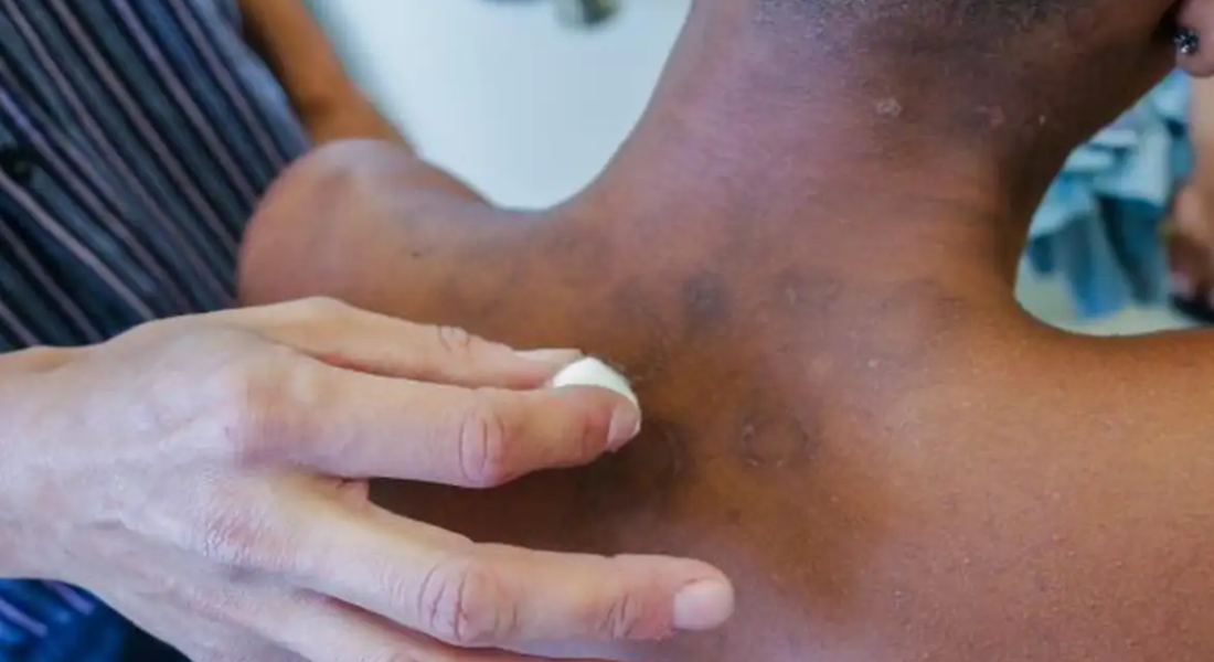 Novos casos de hanseníase aumentaram 5% de janeiro a novembro de 2023