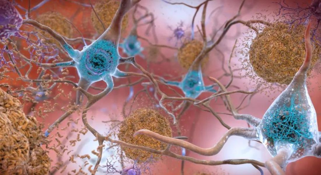 Ilustração mosra placas de proteína beta-amiloide (em laranja) entre neurônios de paciente com Alzheimer