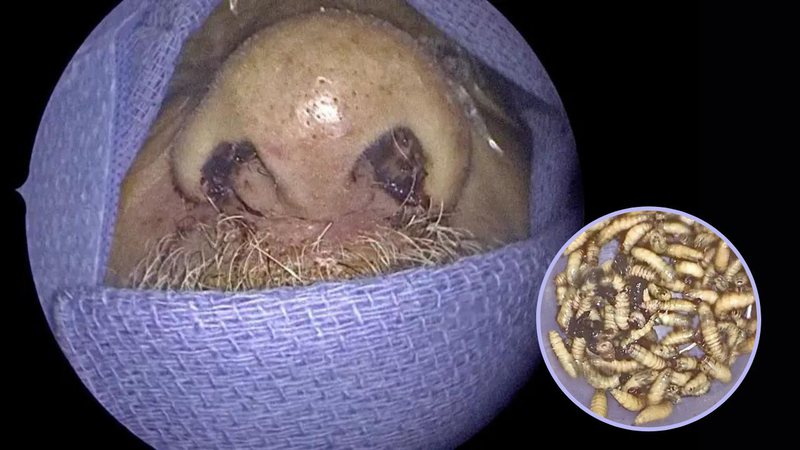 Homem tira mais de 100 larvas do nariz e rosto nos Estados Unidos