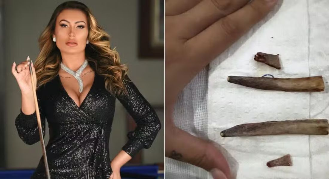 Andressa Urach compartilhou foto após remoção parcial das costelas