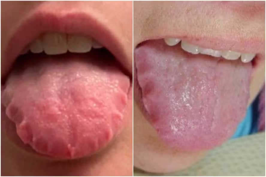 Problema conhecido como 'língua recortada' pode indicar problemas de saúde 