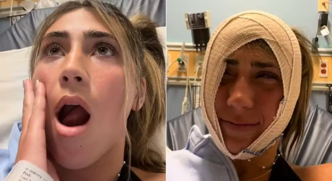 Mulher fica com a mandíbula travada por 4 horas após bocejar muito forte