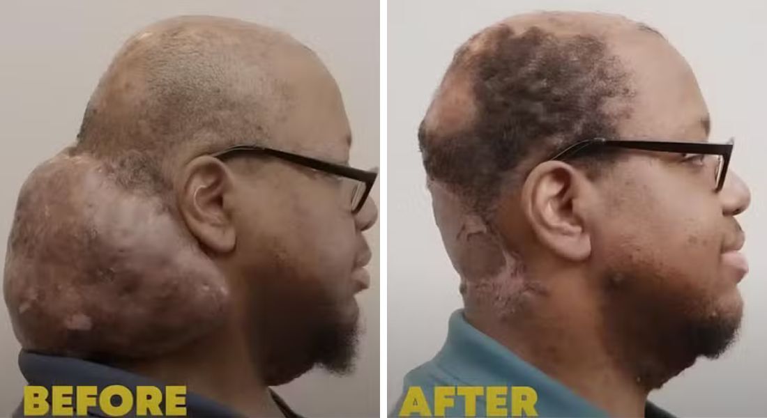 Antes e depois do caroço