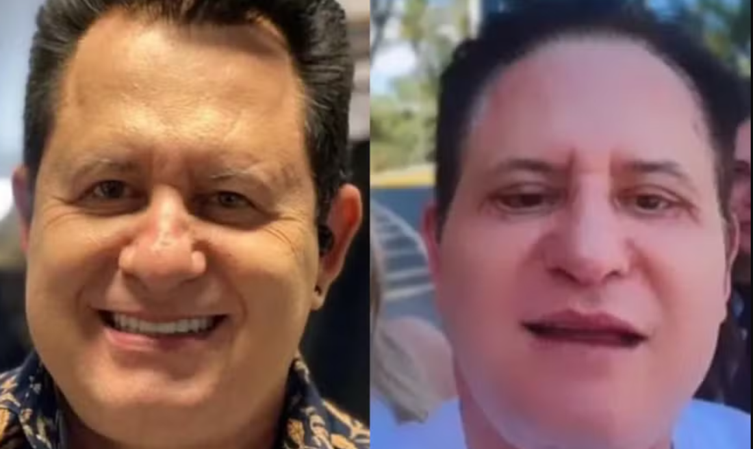 Harmonização facial: antes e depois de Marrone, da dupla com Bruno 