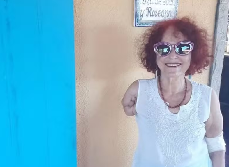 Moradora de Saquarema, a escritora Roseana Murray perdeu um braço após ser atacada, em abril, por três pitbulls 