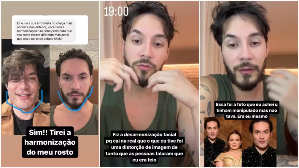 Eliezer reverteu harmonização facial