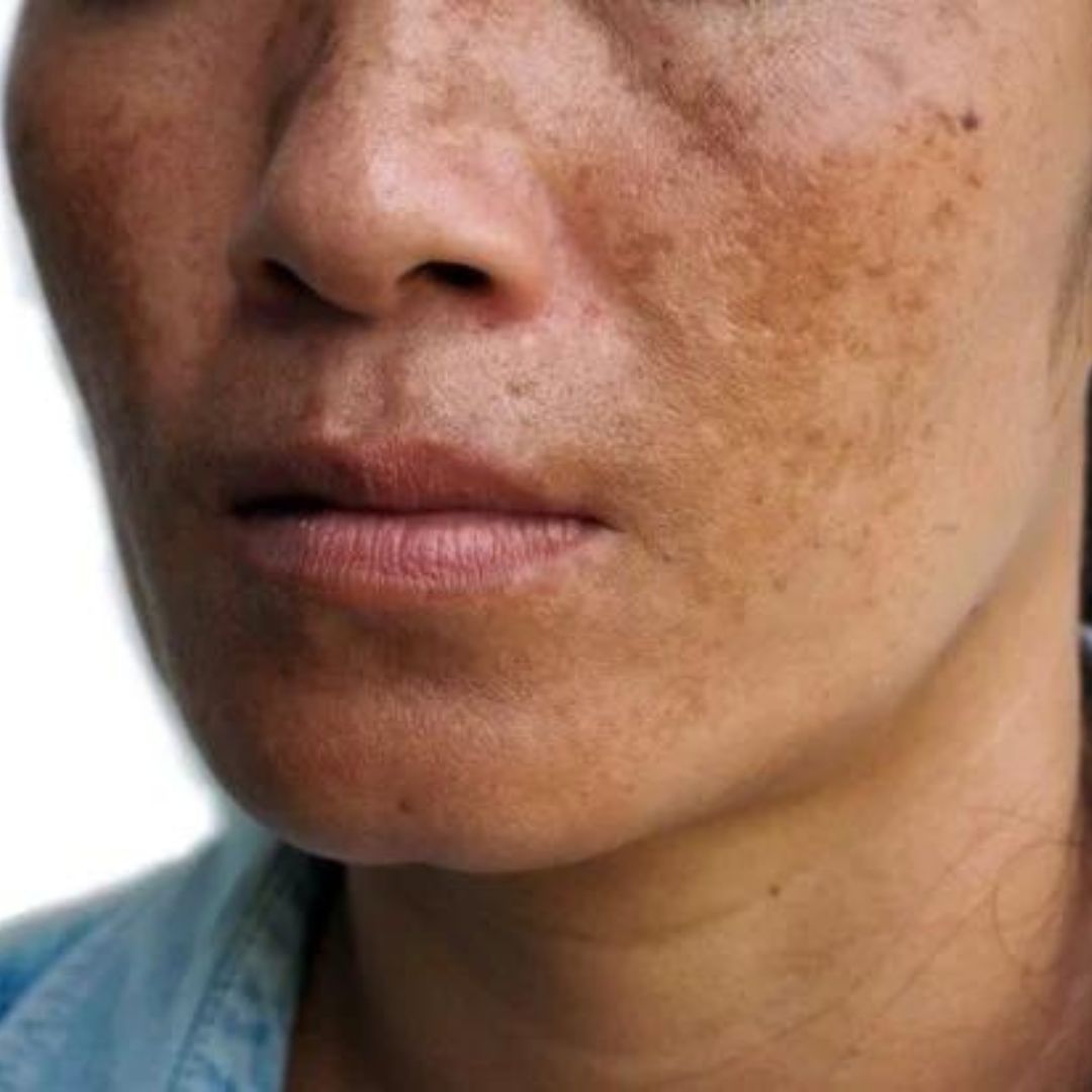 Mulher com melasma