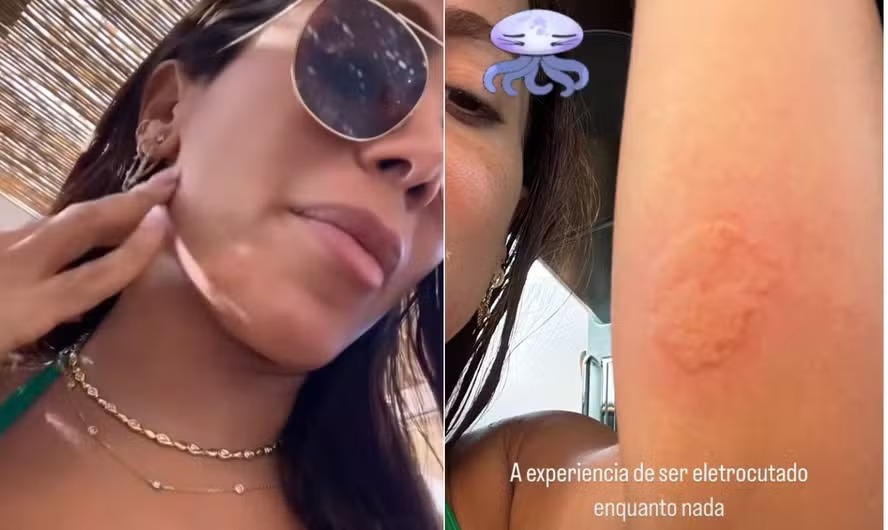 Anitta foi atingida por uma água-viva 