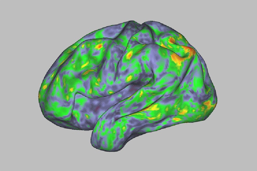 Mapeamento por ressonância magnética indica regiões do córtex cerebral afetadas pela psilocibina. 