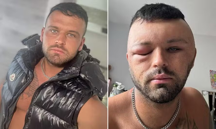 Antes e depois de Ryan Brigg, que utilizou uma tintura no cabelo 