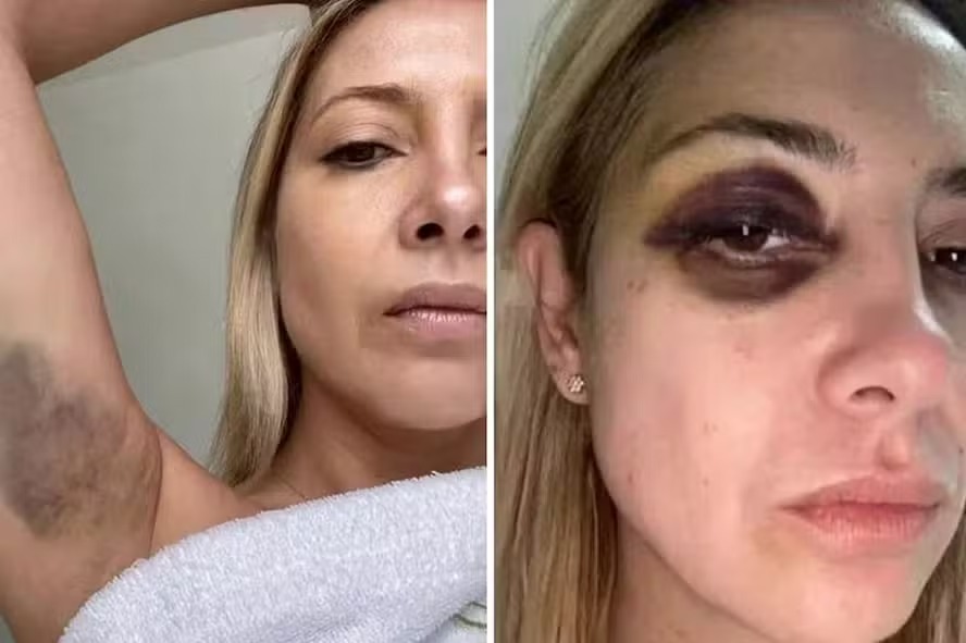 A ex-primeira-dama Fabíola Yañez mostra hematomas no braço e olho roxo; imagens são parte da acusação contra ex-presidente da Argentina Alberto Fernández 