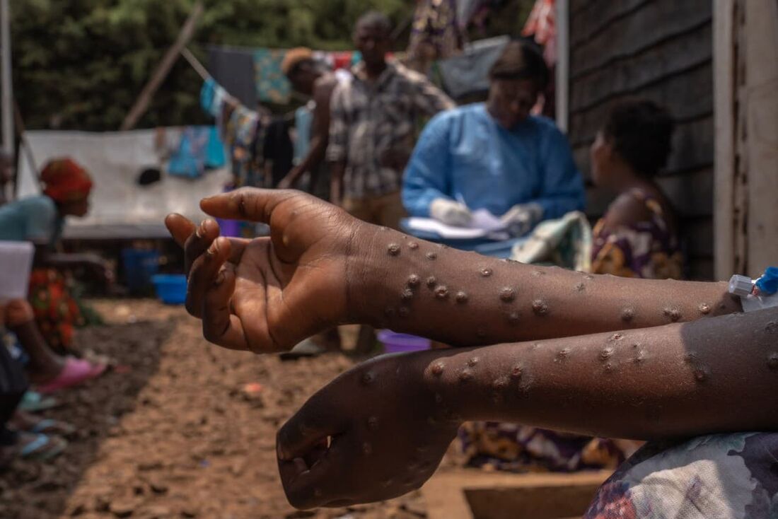 As vacinas contra mpox foram administradas na África pela primeira vez, com várias centenas de indivíduos de alto risco vacinados em Ruanda