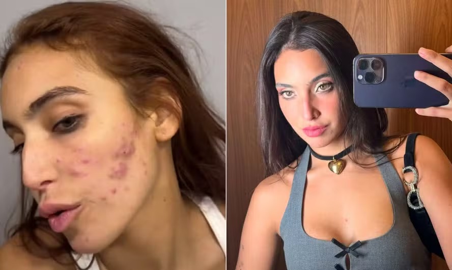 Vanessa Lopes mostra acnes em seu rosto após reação a medicamentos 