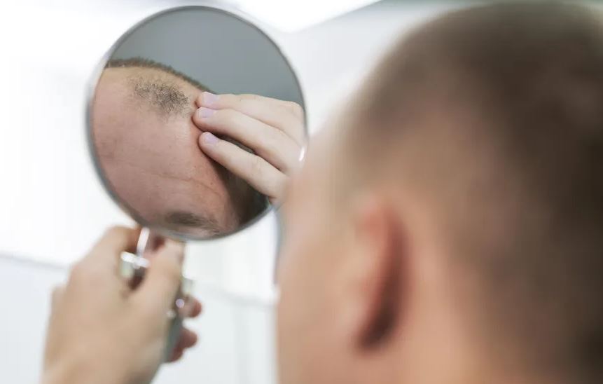 Pessoas que bebem regularmente têm 1,4 vezes mais probabilidade de sofrer de alopecia