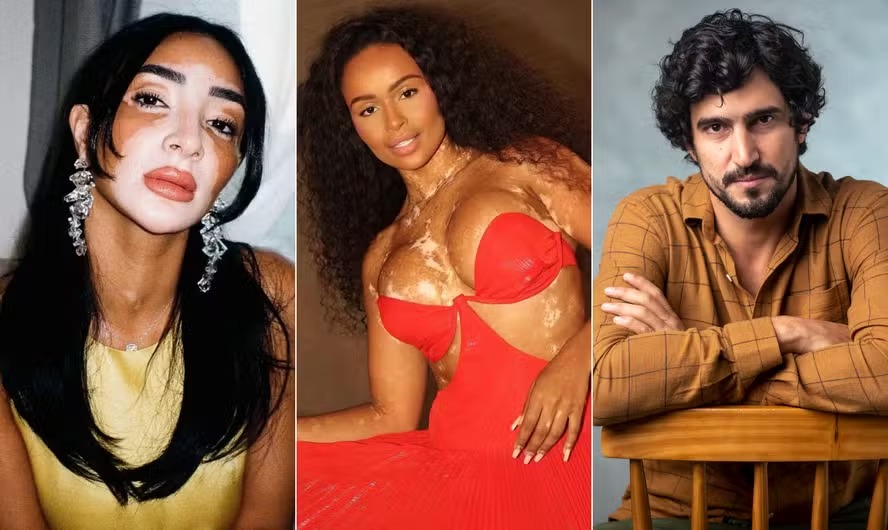 Logina Salah, Natália Deodato e Renato Góes convivem com vitiligo 