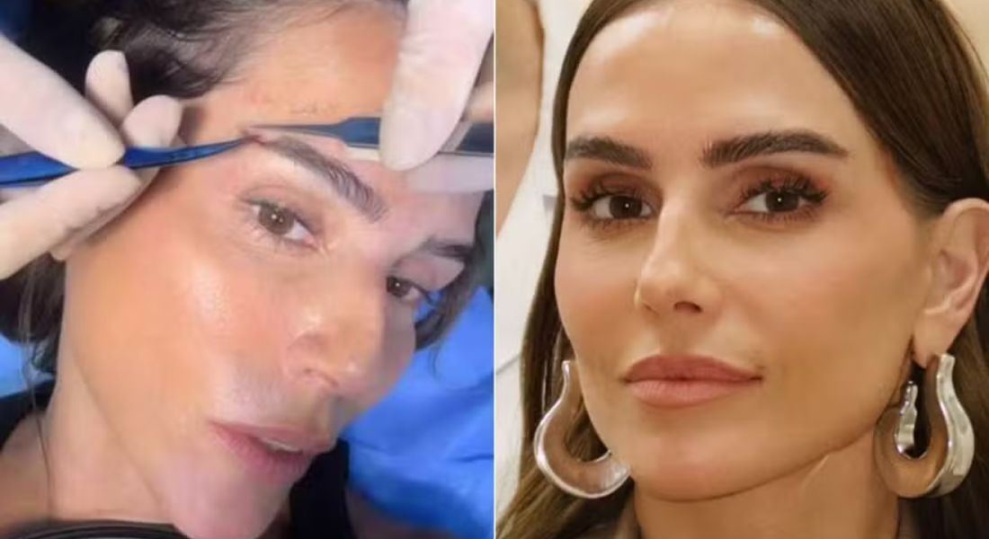 Transplante de sobrancelha: entenda o que é o procedimento feito por Deborah Secco