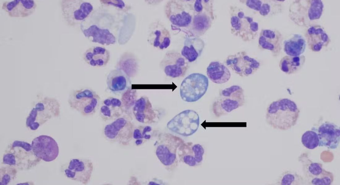 Ameba Naegleria fowleri no fluido cerebrospinal de uma pessoa