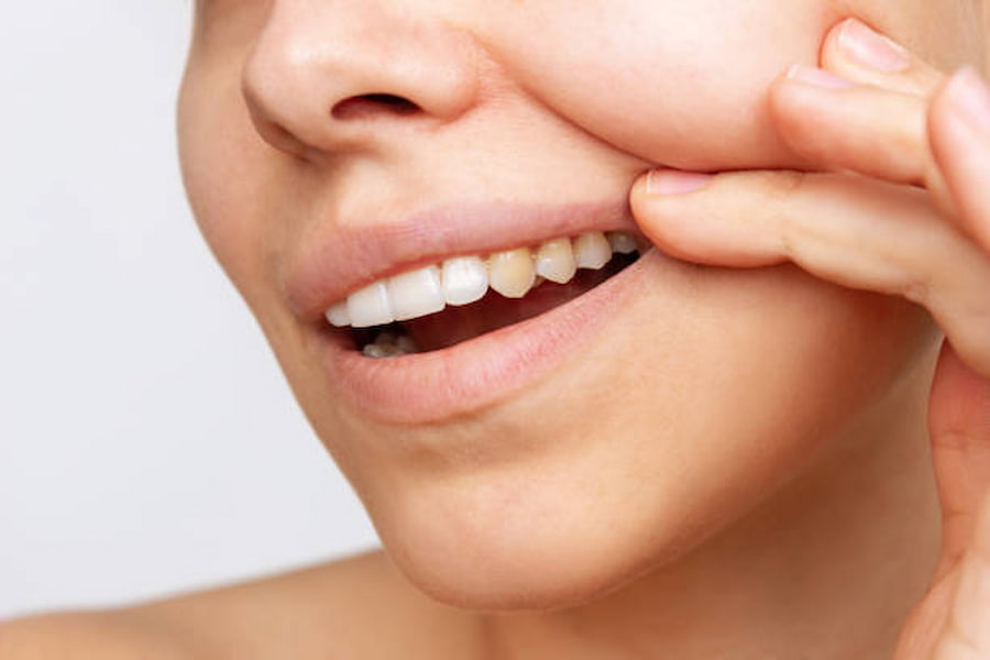 Manter os dentes brancos tornou-se um tema importante para as pessoas, pois está associado à saúde e à beleza.