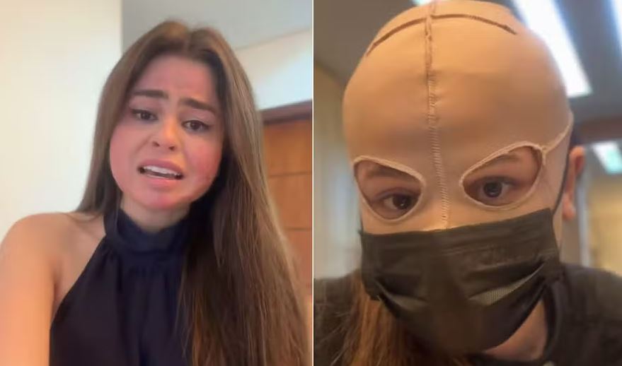 Isadora Milhomem compartilhou relato sobre queimaduras sofridas no rosto após peeling