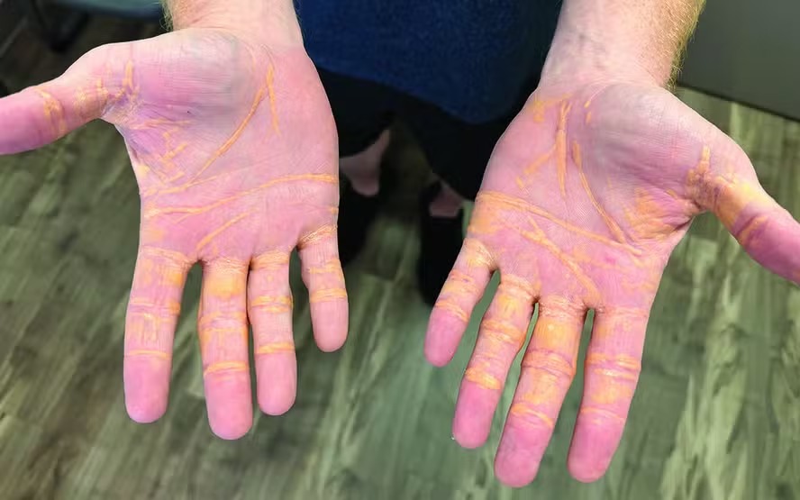 Caso raro faz colesterol 'vazar' nas mãos de americano