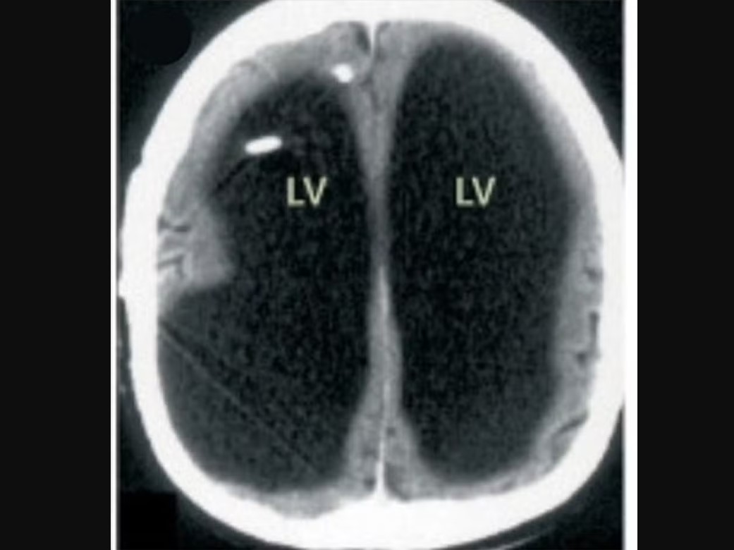 Imagem de raio-X mostra a massa negra na metade do cérebro de homem cuja identidade não foi revelada