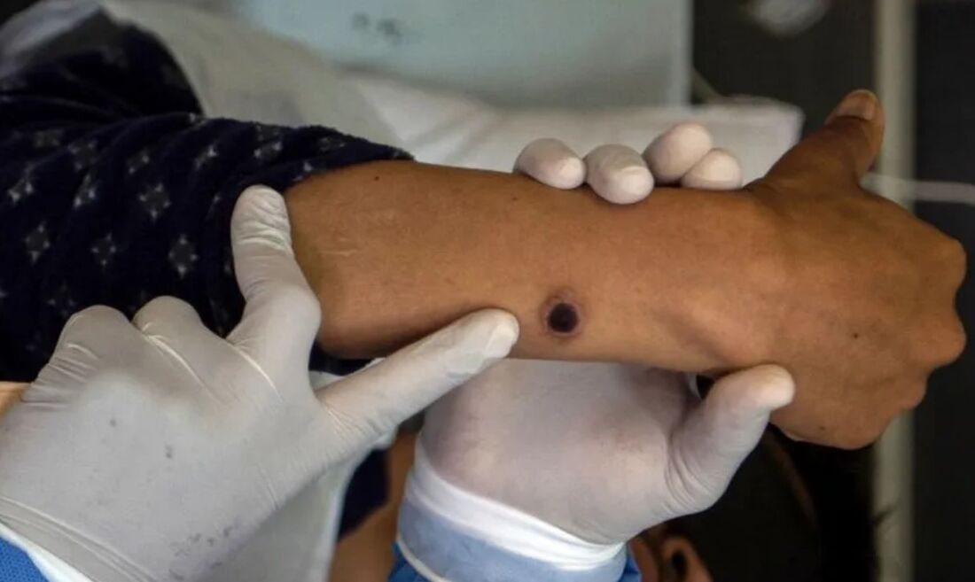 Paciente com monkeypox é examinado no hospital Arzobispo Loayza em Lima, no Peru