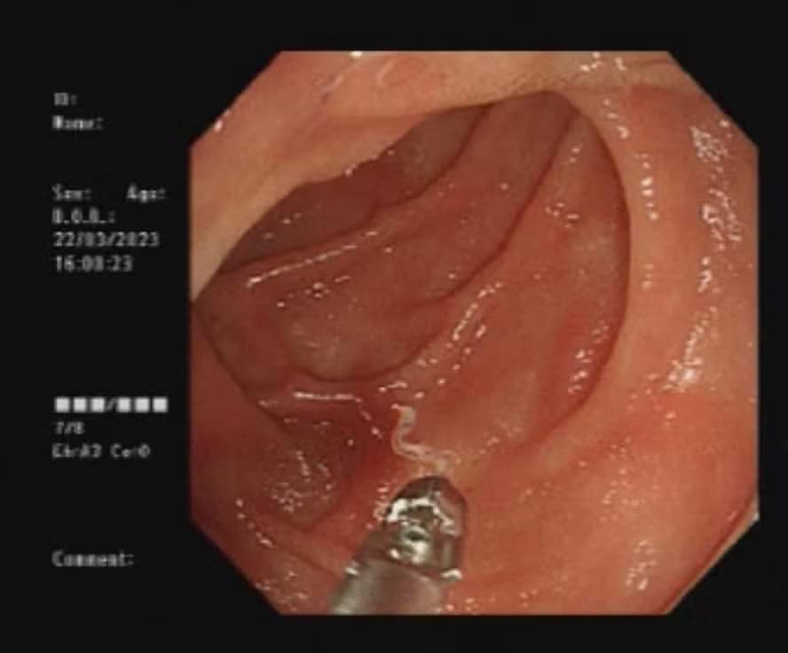 Vermes sugadores de sangue foram encontrados em mulher