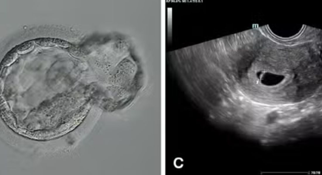 Nasce 1º bebê concebido por processo de fertilização totalmente automatizado