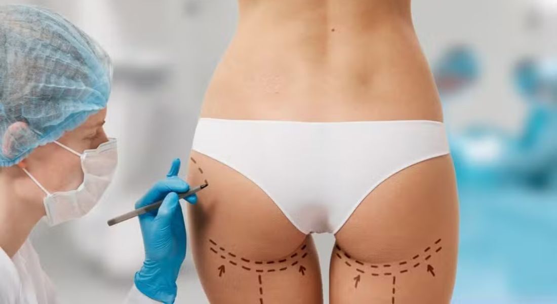 Roundglúteo, sustentação de PDO: os novos tratamentos que as celebridades fazem para moldar o bumbum