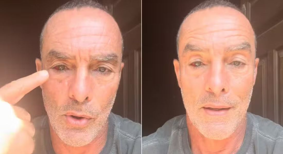 Paulo Zulu com derrame oculo