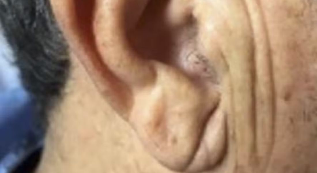 Linha no lóbulo da orelha 