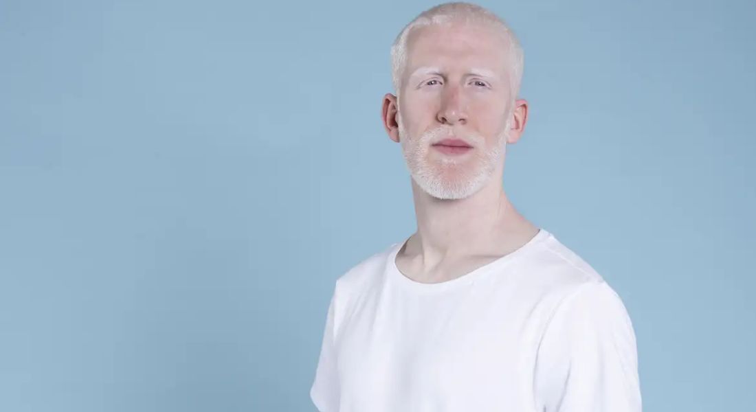 Sancionada lei que cria política de proteção a pessoas com albinismo