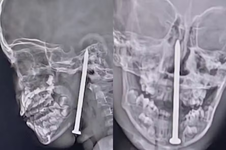 Menino estava brincando quando sofreu uma queda e acabou caindo diretamente sobre um prego