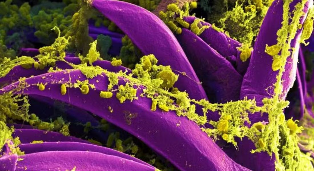 Peste é uma doença infeciosa causada pela bactéria "Yersinia pestis"