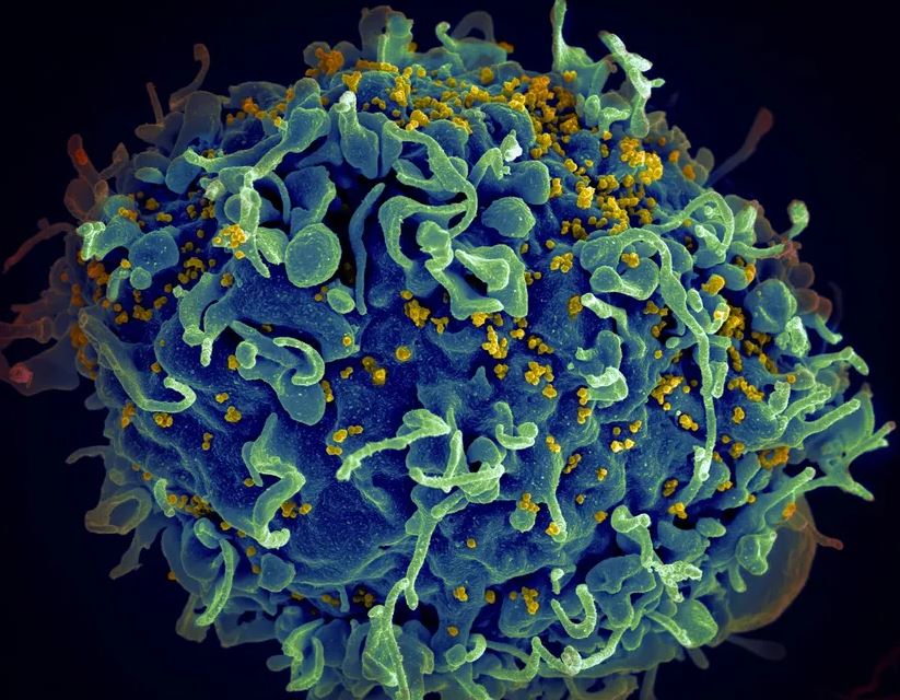 O vírus do HIV (amarelo), infectando uma célula humana. 
